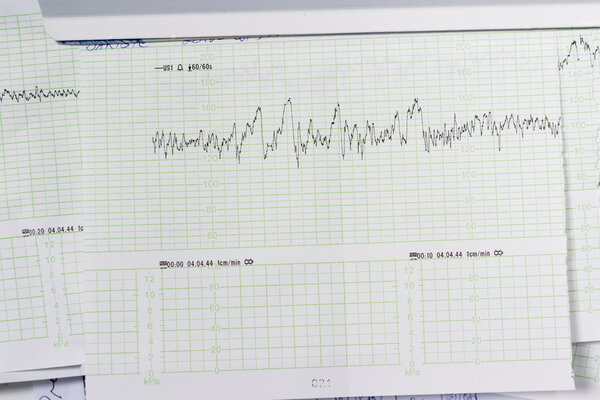 График медицинских открытий. Нерегулярные линии на зеленой сетке
.