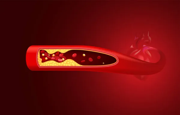 心脏前面的红血球和胆固醇堵塞 — 图库矢量图片