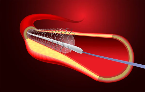 illustration of stent implantation to support blood flow into the blood vessels.