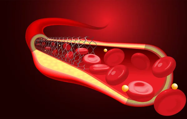 Medical Educational Illustrations Stent Already Placed — Wektor stockowy