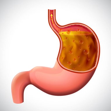 gastroesophageal reflux disease illustration for medical and educational use. clipart