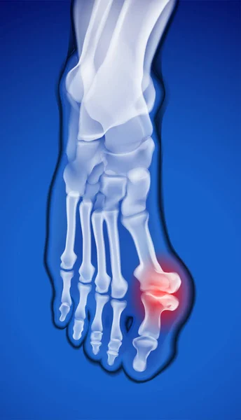 大拇指关节骨质异常导致严重疼痛的足部X光检查 — 图库矢量图片