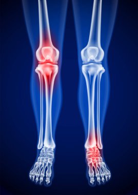 İnsan kalçalarının, dizlerinin ve ayaklarının röntgen görüntüleri. Acı noktalarını kırmızıyla göster.