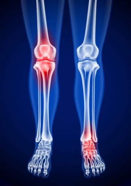 İnsan kalçalarının, dizlerinin ve ayaklarının röntgen görüntüleri. Acı noktalarını kırmızıyla göster.