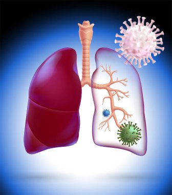 Pulmoner koronavirüs hücreleri içeren akciğerlerdeki solunum sisteminin dallarını vurgulamak için yarı saydam bir insan akciğerinin 3 boyutlu çizimi.
