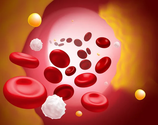 Ilustracja Czerwonych Krwinek Białych Krwinek Cholesterolu Zatykających Przyczynę Śmierci — Wektor stockowy
