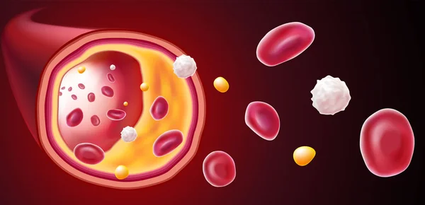 Ілюстрація Еритроцитів Білих Кров Яних Клітин Забивання Холестерину Причина Смерті — стоковий вектор