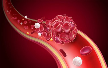 3D illustration of a blood clot in a blood vessel showing a blocked blood flow with platelets and white blood cells in the image. clipart