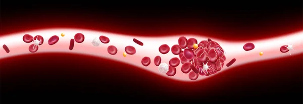 Illustration Blood Clot Blood Vessel Showing Blocked Blood Flow Platelets — Image vectorielle