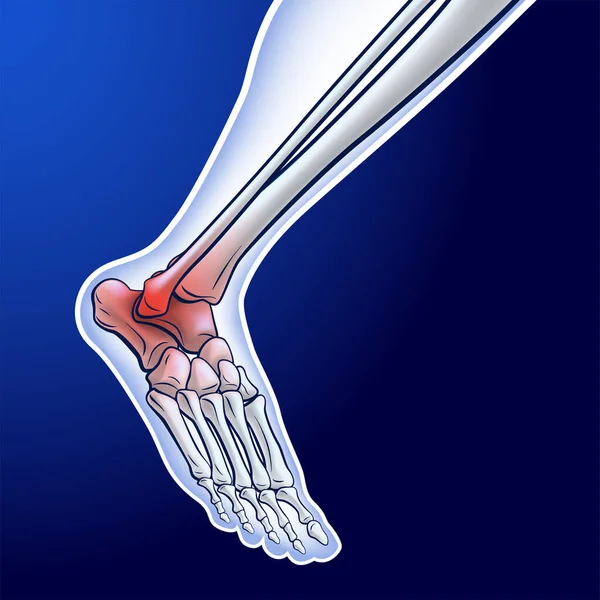 Illustration Running Ankle Bone Showing Red Dots Representing Joint Injury — Image vectorielle