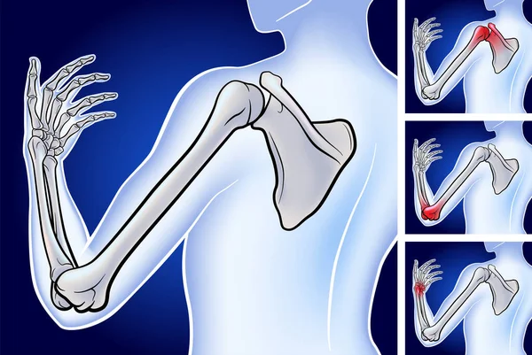 从肩胛骨到指尖的三维图显示了深蓝色背景下三个痛点的位置 — 图库矢量图片