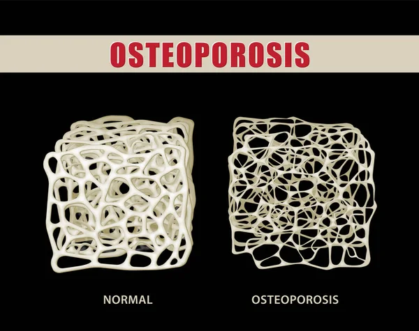 Osteoporoz ile siyah arka plandaki normal kemiği karşılaştırma 3B illüstrasyon.