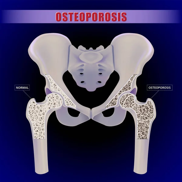 Illustration Human Hip Bone Comparing Normal Bone Symptoms Osteoporosis — Stock Vector