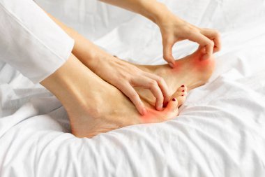 Evdeki beyaz yatakta oturan kadınların el tırnaklarının yan görüntüsü. Kaşındırıcı deri, mantar, mantar bakteriyel enfeksiyon alerjik reaksiyon, egzama, ayak dermatiti. Sağlık ve cilt bakımı.