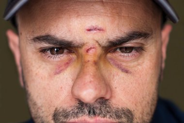 Black eyes of a injured man clipart