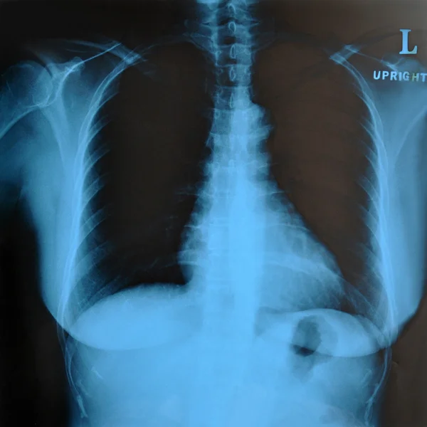 Imagen de rayos X de la mama de una mujer — Foto de Stock