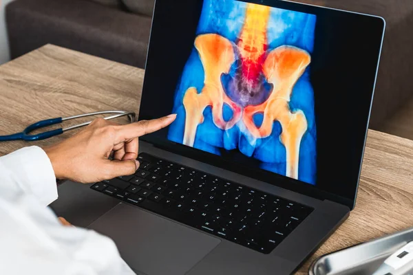 Doctor showing a x-ray of pain in the hips on a laptop. . High quality photo