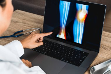 Close up of doctor showing a x-ray of pain in the knee. High quality photo
