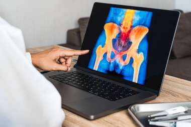Doctor showing a x-ray of pain in the hips on a laptop. . High quality photo