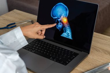 Doctor showing a x-ray of pain in the brain. Migraine Headache concept. High quality photo