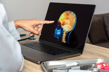 Doctor showing a x-ray of pain in the brain. Migraine Headache concept. High quality photo