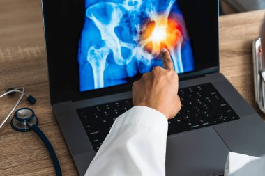 Doctor showing a x-ray of pain in the hips on a laptop. . High quality photo