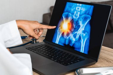 Doctor showing a x-ray of pain in the hips on a laptop. . High quality photo