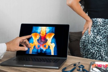 Doctor showing a x-ray of pain in the hips on a laptop. Woman patient in the background. High quality photo