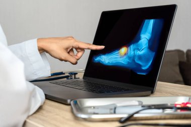 Close up of doctor showing a x-ray of foot. Pain foot injury. High quality photo