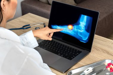 Close up of doctor showing a x-ray of foot. Pain foot injury. High quality photo