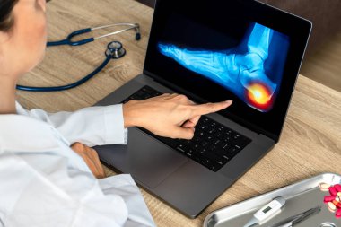 Close up of doctor showing a x-ray of foot. Pain heel and foot injury. High quality photo