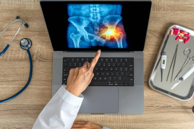 Top view of doctor showing a x-ray of pain in the hips on a laptop. . High quality photo