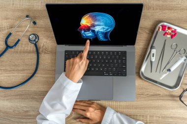 Top view of doctor looking a x-ray of pain in the brain on a laptop. Migraine Headache concept. High quality photo
