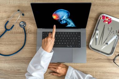 Top view of doctor looking a x-ray of pain in the brain on a laptop. Migraine Headache concept. High quality photo