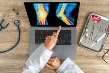 Top view of doctor showing a x-ray of pain in the knee. High quality photo