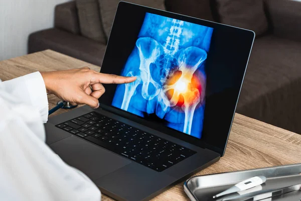 Doctor showing a x-ray of pain in the hips on a laptop. . High quality photo