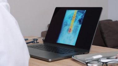 Kadın doktor dizüstü bilgisayarında omurgasında ağrı olan röntgenini gösteriyor. İleri fırladı. Yüksek kalite 4k görüntü