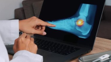 Kadın doktor, dizüstü bilgisayarda ayak bileğinde ağrı olan bir ayak röntgeni gösteriyor. Yakın çekim. Yüksek kalite 4k görüntü