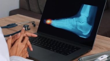 Woman doctor showing a x-ray of foot with pain in the toes on a laptop. Close up shot. High quality 4k footage