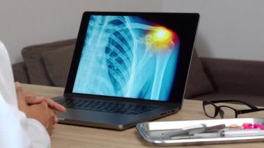 Close up of hand of a woman doctor showing a x-ray of pain in shoulder on a laptop. High quality 4k footage