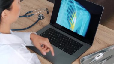 Woman Doctor showing x-ray with pain on the ribs on a laptop. View over the shoulder. High quality 4k footage