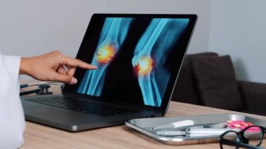 Woman Doctor showing x-ray with pain in the knees on a laptop. Left to right shot. High quality 4k footage