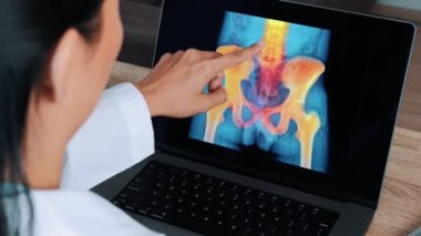 Woman Doctor showing x-ray with pain in the hips and spine on a laptop. Left to right shot above the shoulder. High quality 4k footage