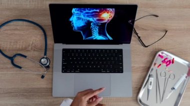 Top view of hand of a woman doctor showing a x-ray of brain on a laptop. Migraine headache concept. High quality 4k footage