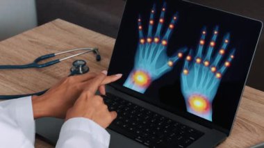 Woman doctor showing a x-ray of hands with pain in the joints and wrist on a laptop. View over the shoulder. High quality 4k footage