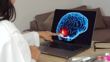 Woman doctor showing a x-ray of brain on a laptop. Migraine headache concept. High quality 4k footage