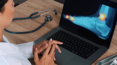 Woman doctor showing a x-ray of foot with pain in the toes and ankle on a laptop. View above the shoulder. High quality 4k footage