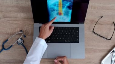 Top view of hand of a woman doctor showing a x-ray of a spine on a laptop. High quality 4k footage