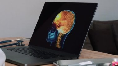 Woman doctor showing a x-ray of skull with pain in the brain on a laptop. Left to right shot. High quality 4k footage