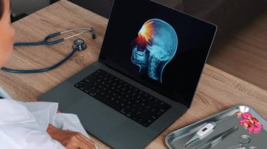Woman doctor showing a x-ray of skull with pain in the forehead on a laptop. View over the shoulder. High quality 4k footage